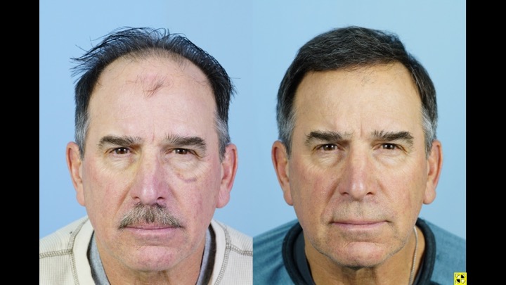 Dr Josephitis hair transplant result 1.jpg