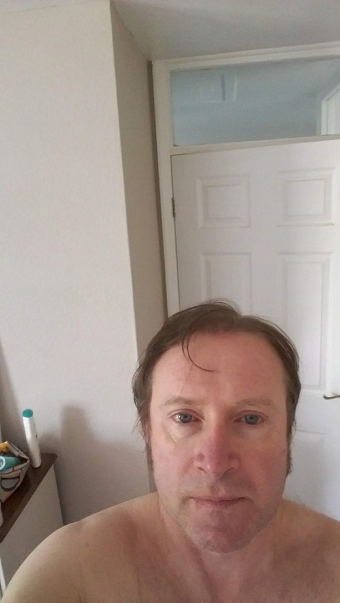 Dr. Karadeniz hair transplant.jpg