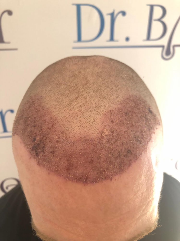 Dr Ozlem Bicer hair transplant.jpeg