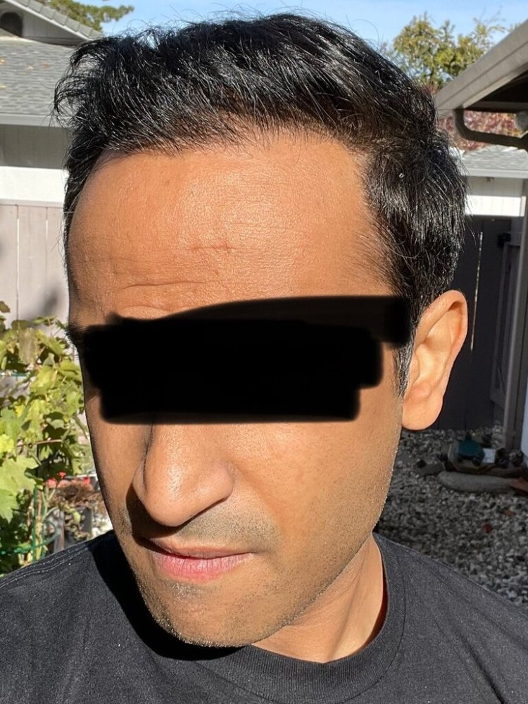 Dr. Ron Shapiro 8.5 months post-op hair transplant5.jpeg
