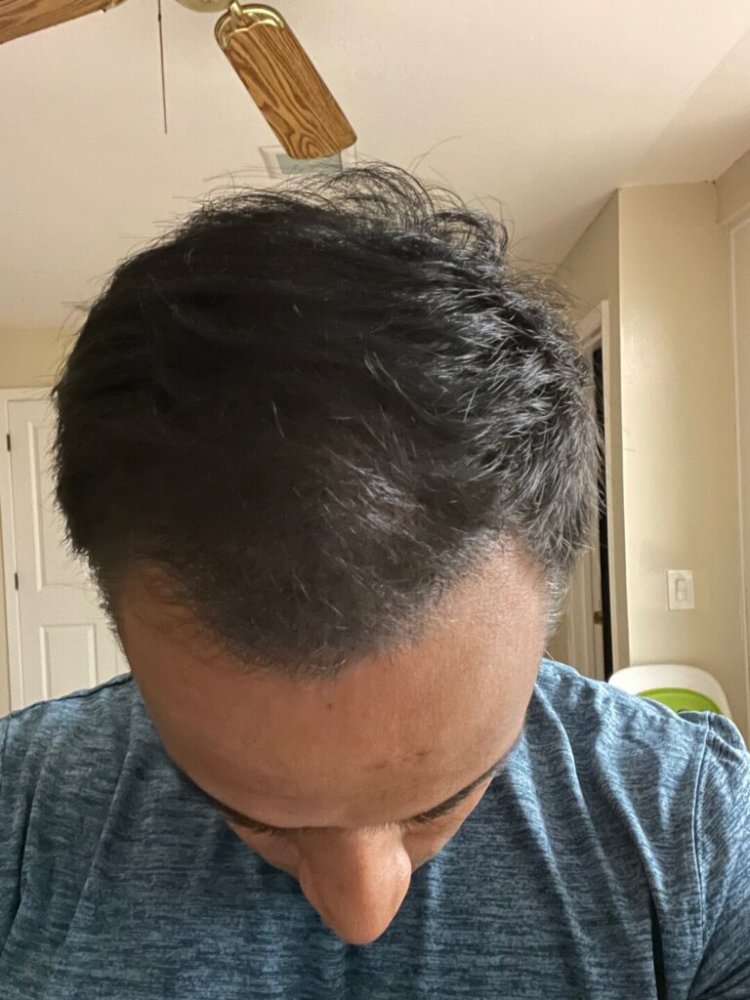 Dr. Ron Shapiro hair transplant 6 months3.jpeg