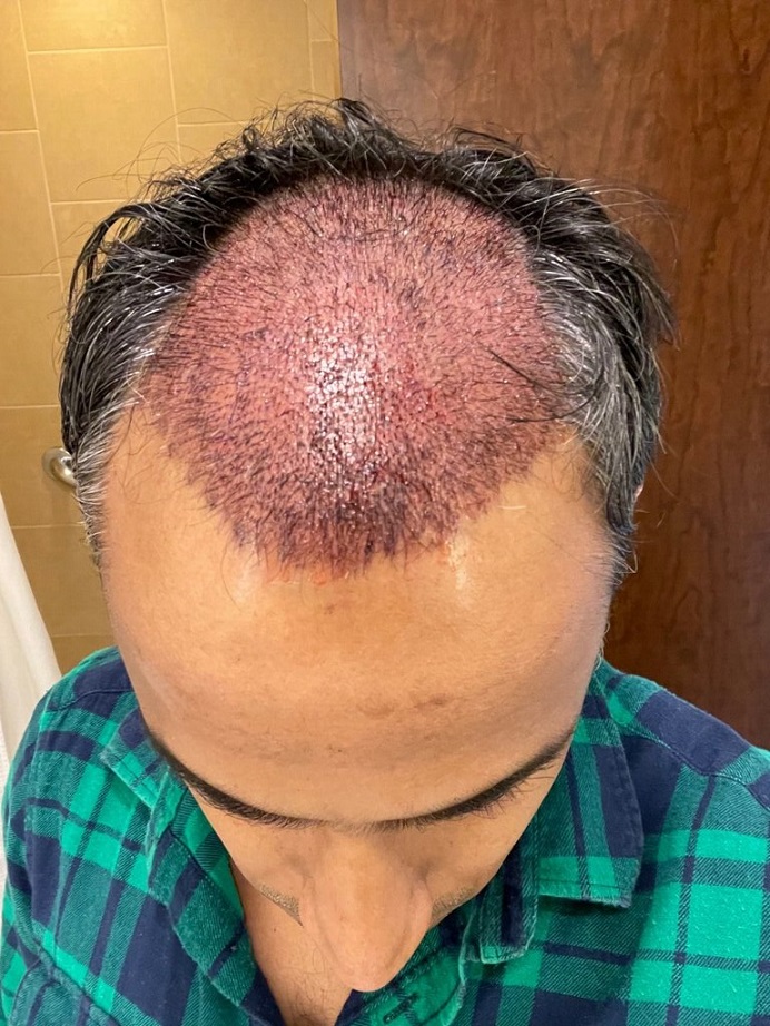 Dr. Ron Shapiro Hair Transplant6.jpeg