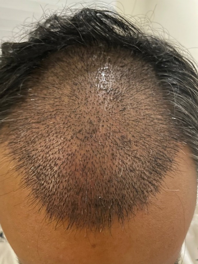 Dr. Ron Shapiro Hair Transplant9.jpeg