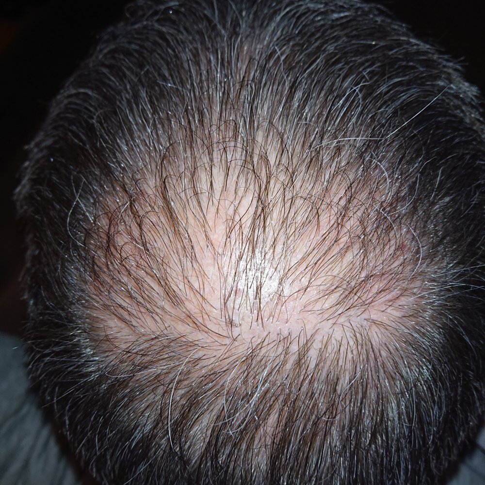 My HT story | Page 2 | Hair loss Forum - Hair Transplant forums