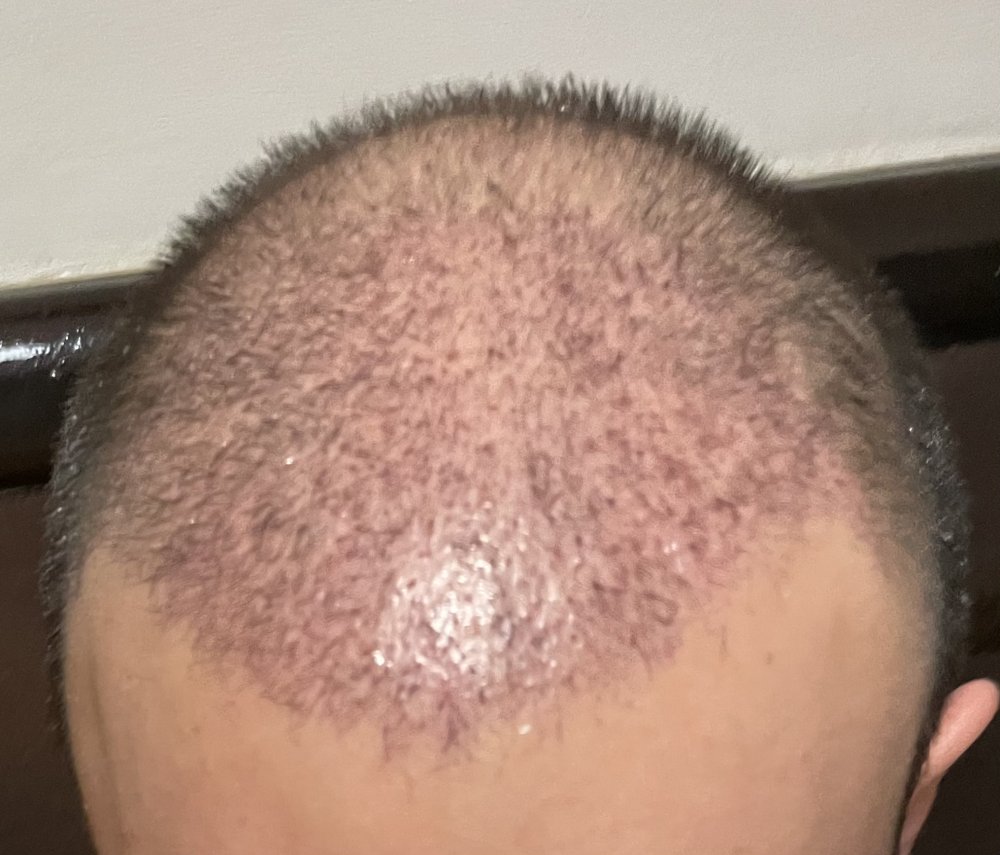 Coconut oil 2 weeks after FUE hair transplant. Damages? Hair loss Forum Hair Transplant forums