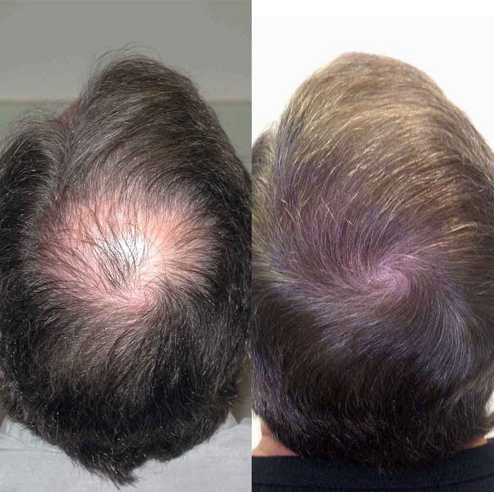 Farjo hair transplant after.jpg
