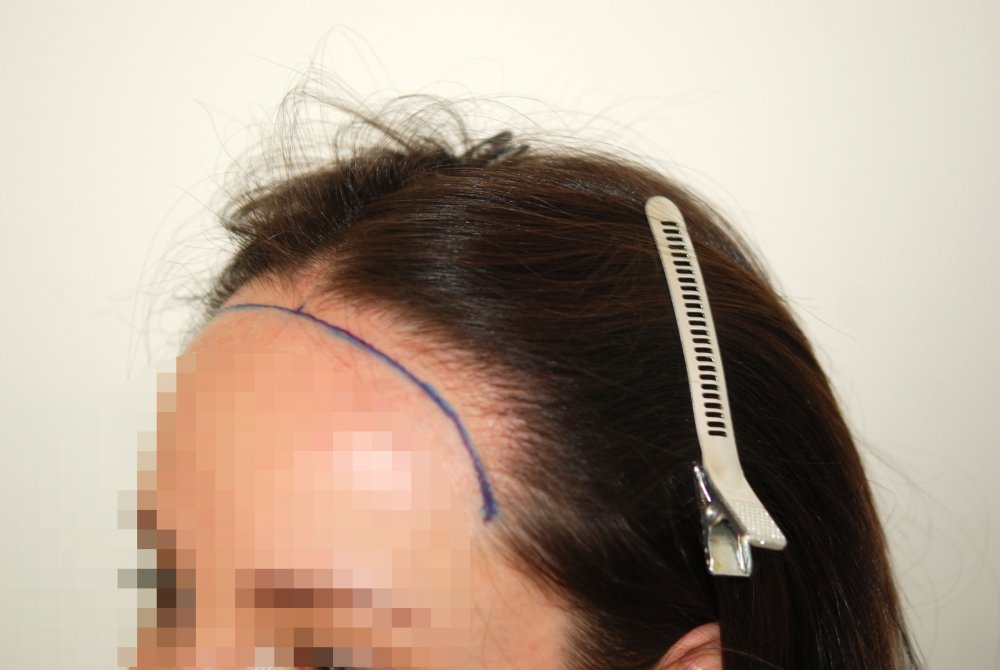 Female hairline hair transplant - Dr. Feriduni24.jpeg