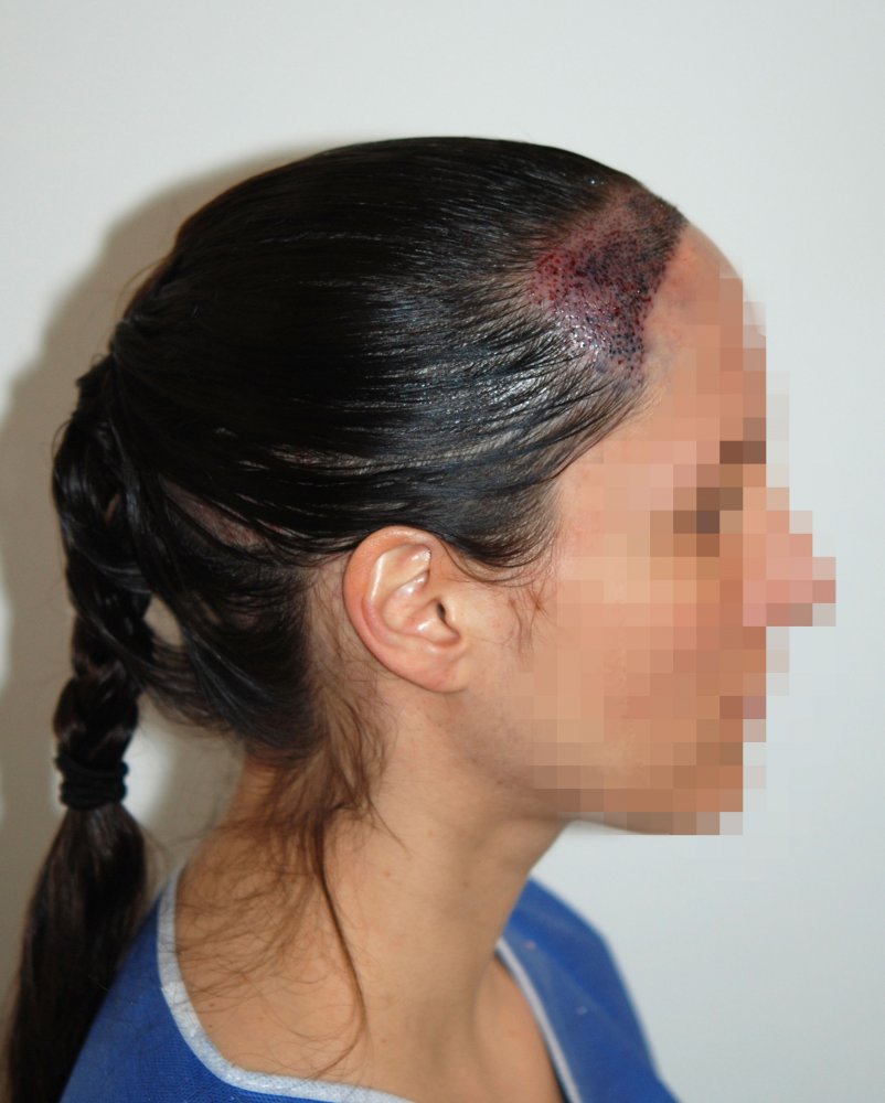 Female hairline hair transplant - Dr. Feriduni5.jpeg