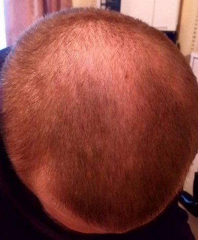 Finasteride 6 months.jpg