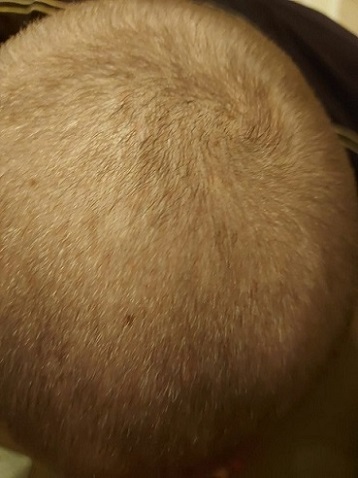 finasteride growth.JPG