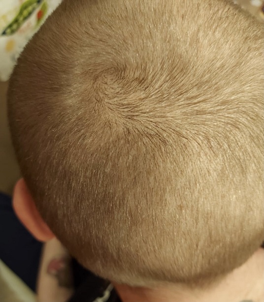 finasteride regrowth.jpg