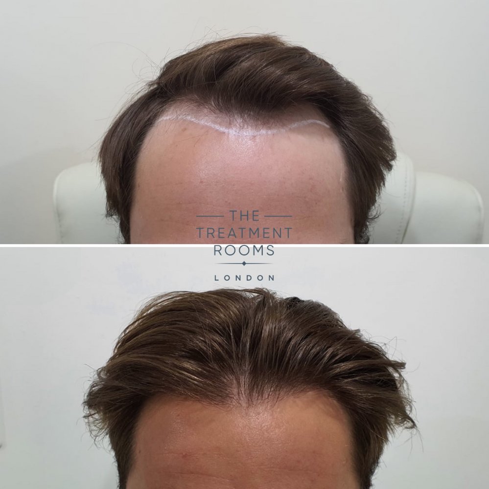 Front Hairline Before and after.jpg