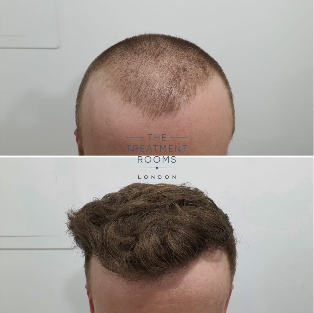 Frontal hairline.jpg