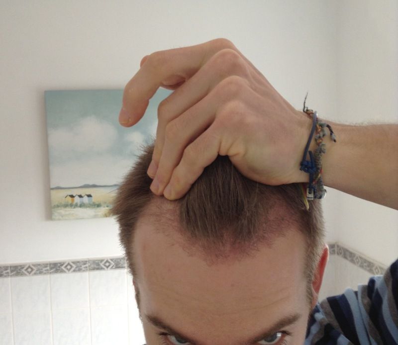 FUE at HDC Cyprus.jpg