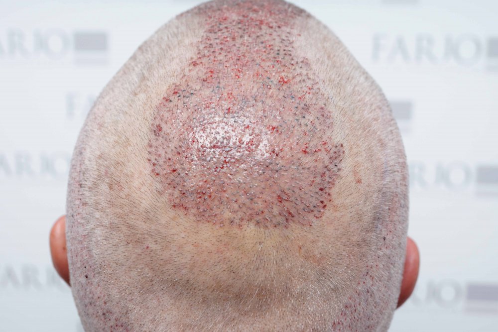 FUE Farjo Hair Institute13.jpg