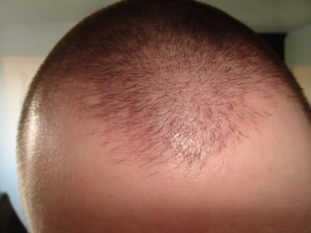 FUE Hair Transplant BHR Clinic1.jpg