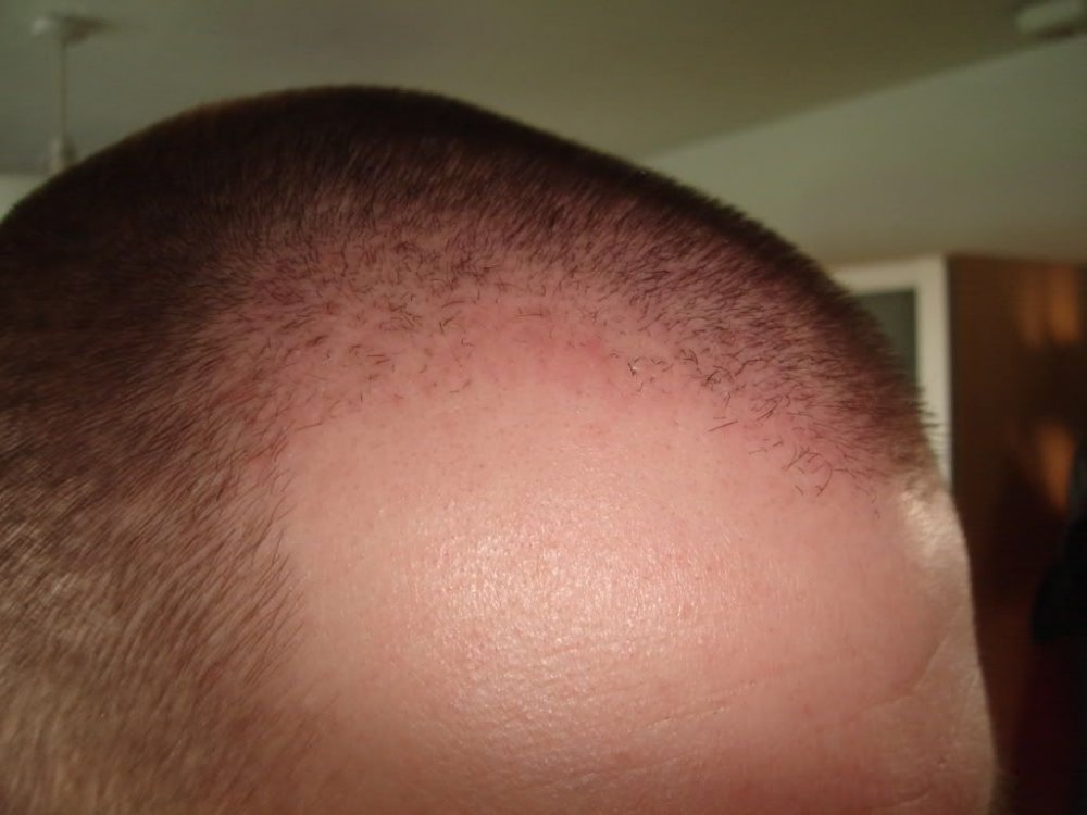 FUE Hair Transplant BHR Clinic2.jpg