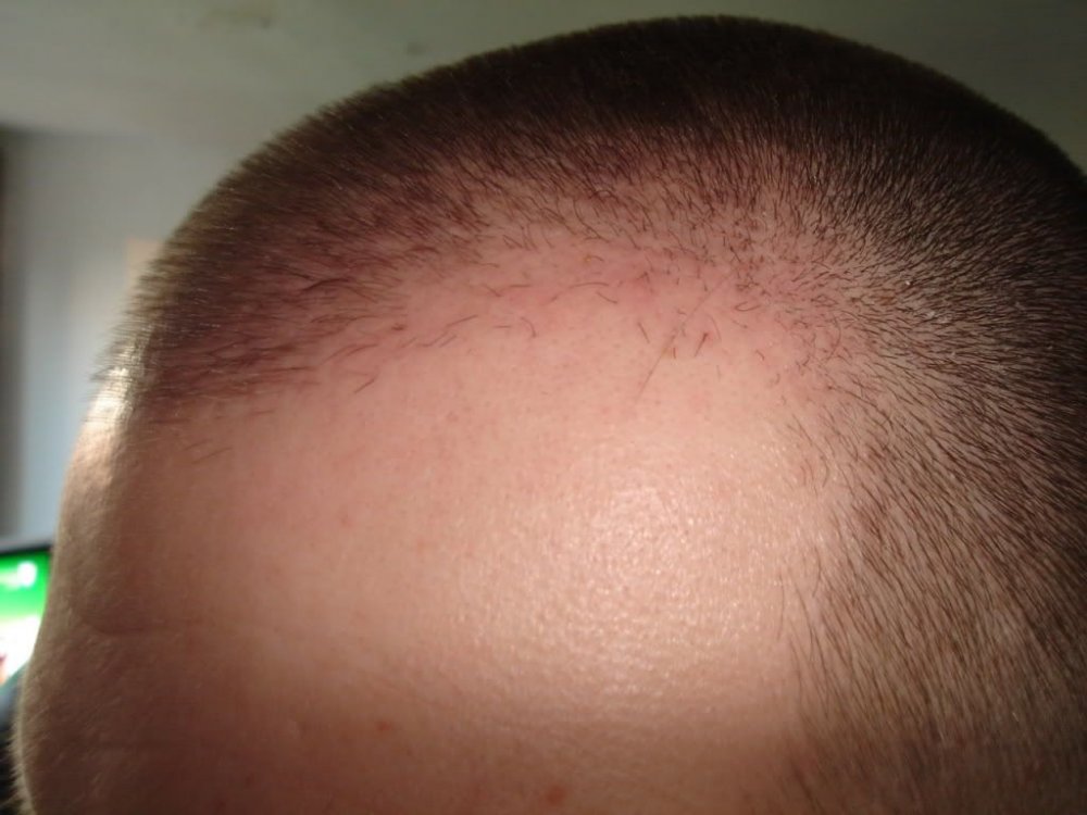 FUE Hair Transplant BHR Clinic3.jpg