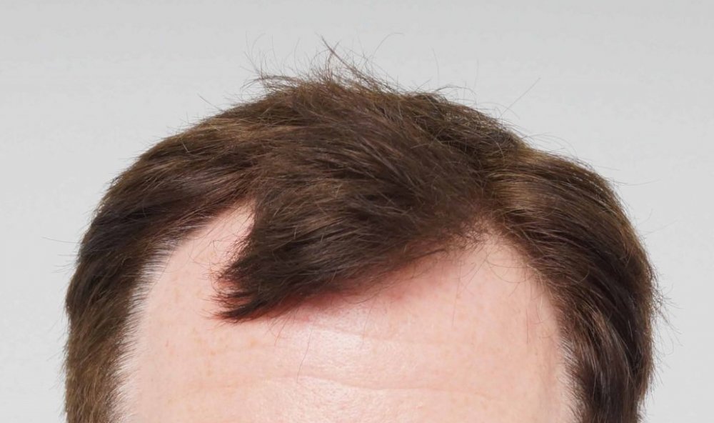 FUE Hair transplant Dr. Bessam Farjo.jpg