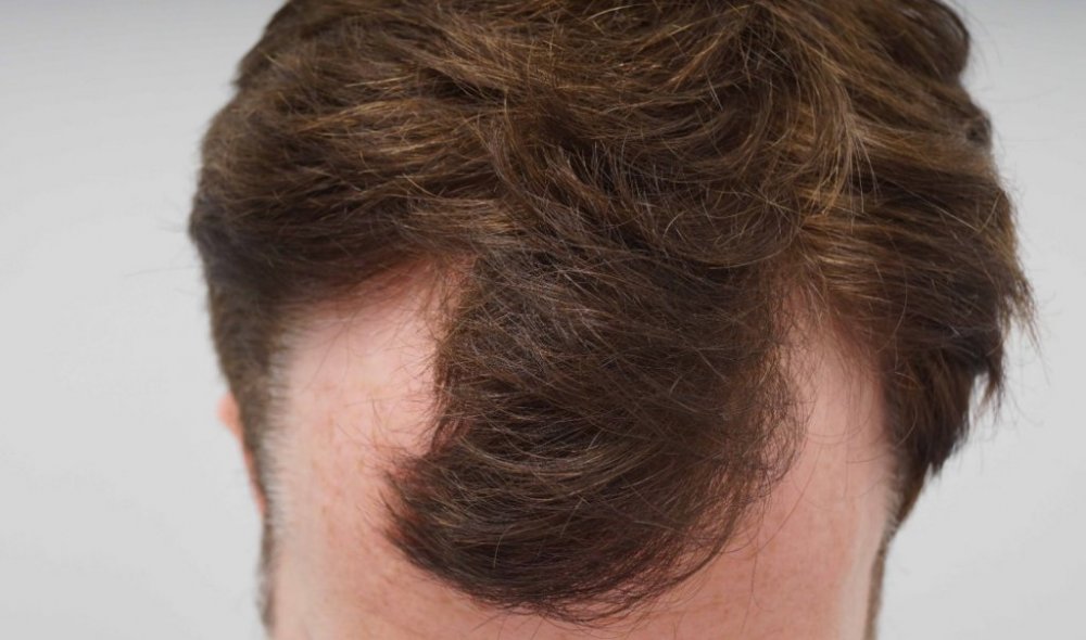 FUE Hair transplant Dr. Bessam Farjo1.jpg