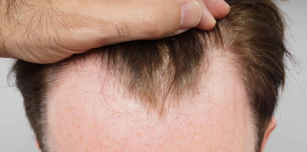 FUE Hair transplant Dr. Bessam Farjo2.jpg