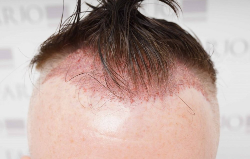 FUE Hair transplant Dr. Bessam Farjo3.jpg