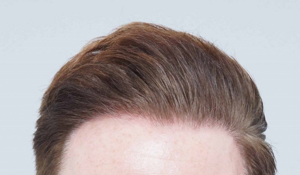 FUE Hair transplant Dr. Bessam Farjo4.jpg
