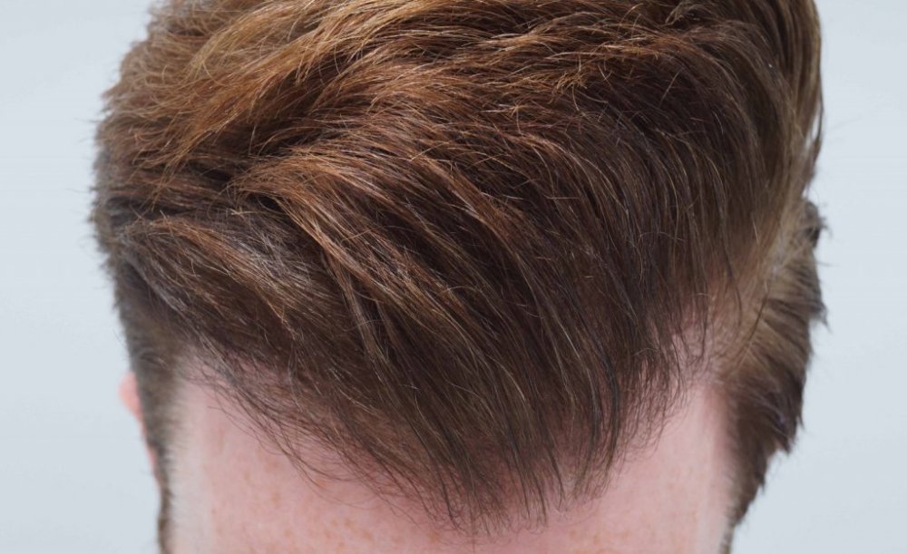 FUE Hair transplant Dr. Bessam Farjo5.jpg