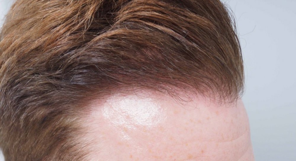 FUE Hair transplant Dr. Bessam Farjo6.jpg