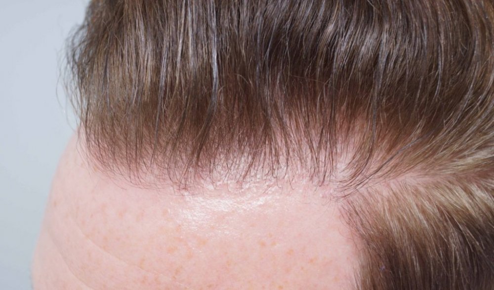 FUE Hair transplant Dr. Bessam Farjo7.jpg