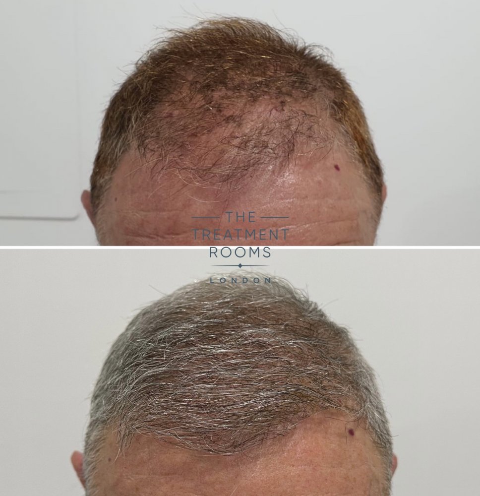 FUE hair transplant result.jpg