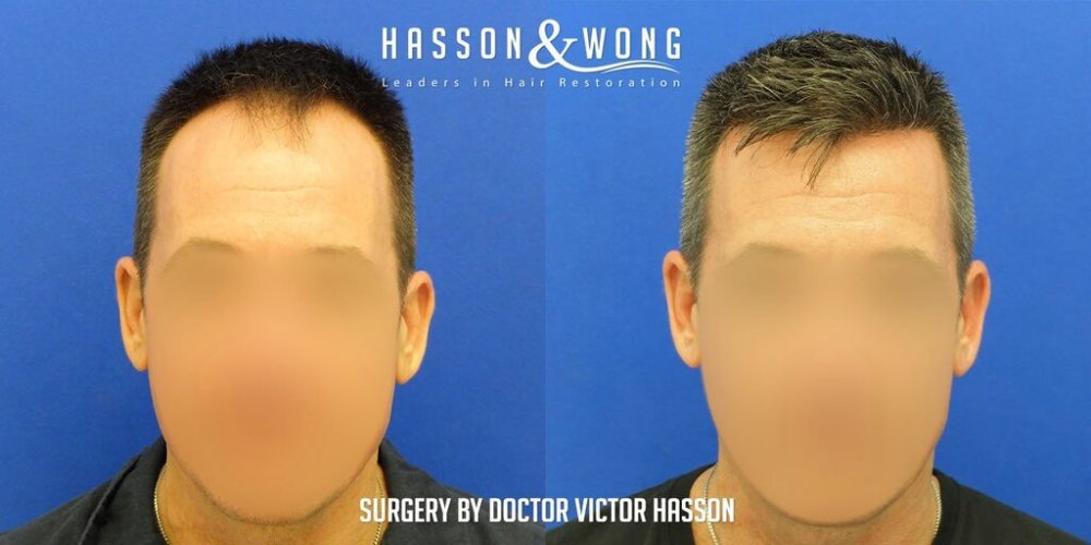 FUE Hair Transplant with Dr. Victor Hasson1.jpg
