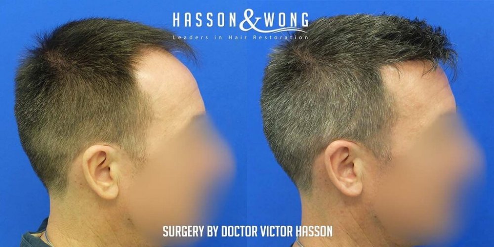 FUE Hair Transplant with Dr. Victor Hasson10.jpg