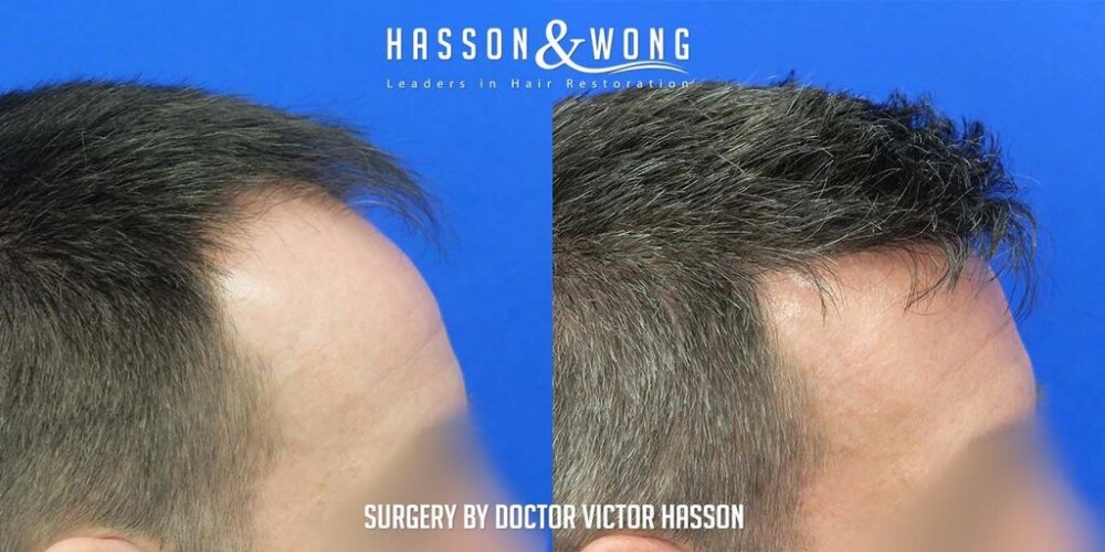 FUE Hair Transplant with Dr. Victor Hasson11.jpg