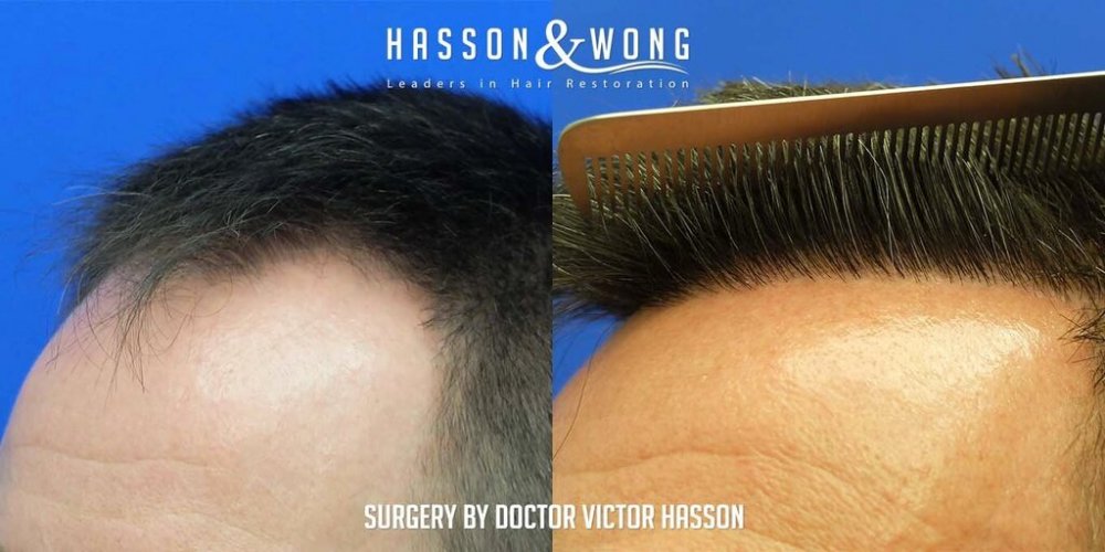 FUE Hair Transplant with Dr. Victor Hasson12.jpg