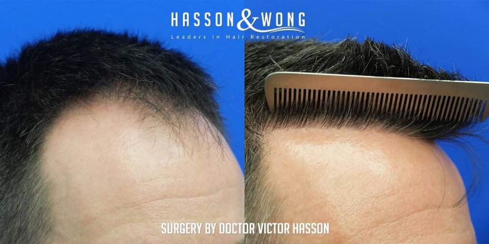 FUE Hair Transplant with Dr. Victor Hasson13.jpg