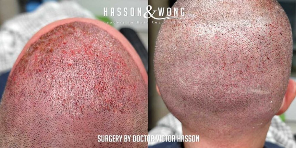 FUE Hair Transplant with Dr. Victor Hasson14.jpg