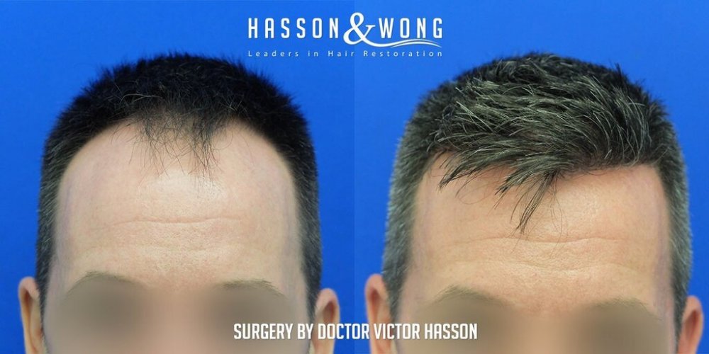 FUE Hair Transplant with Dr. Victor Hasson2.jpg