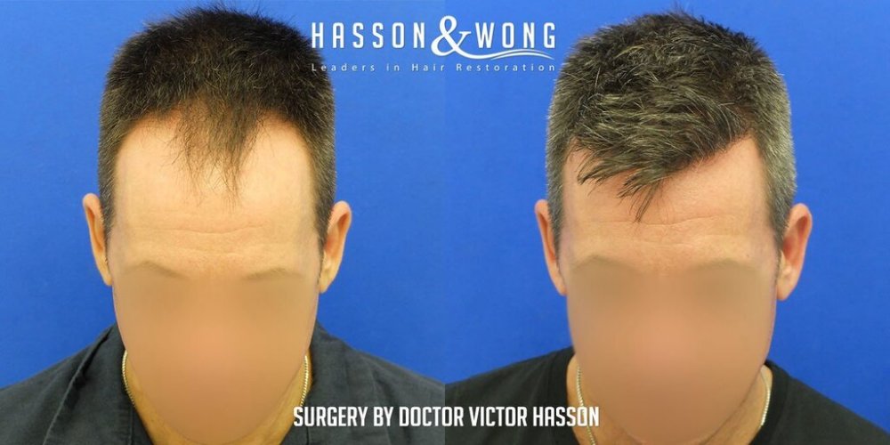 FUE Hair Transplant with Dr. Victor Hasson3.jpg