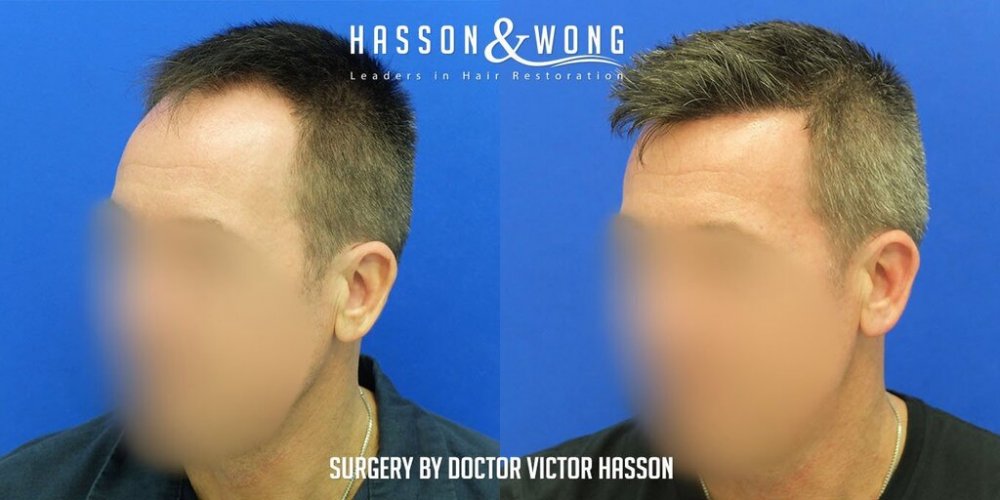 FUE Hair Transplant with Dr. Victor Hasson4.jpg