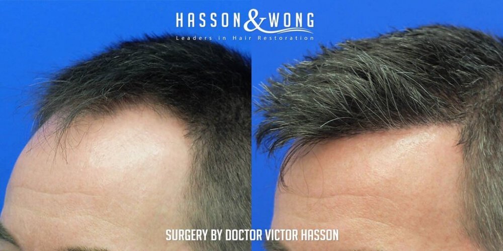 FUE Hair Transplant with Dr. Victor Hasson5.jpg