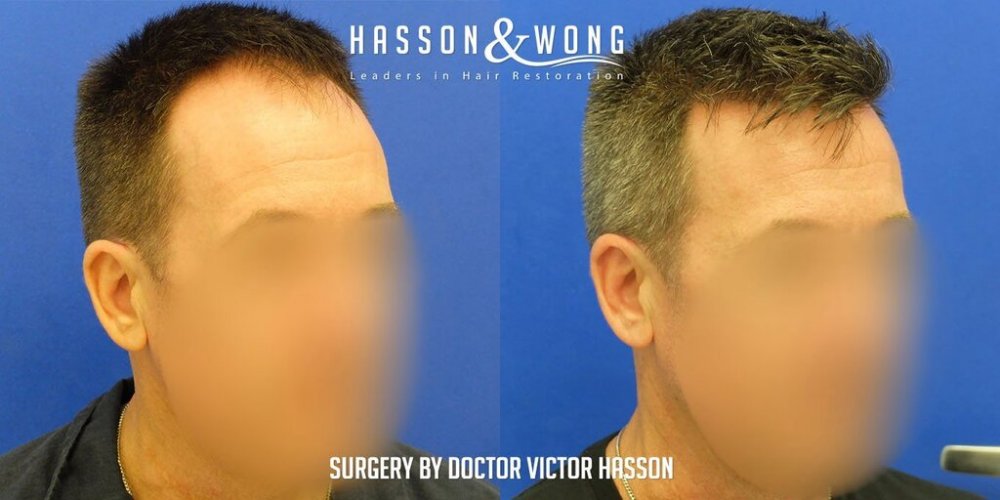 FUE Hair Transplant with Dr. Victor Hasson6.jpg