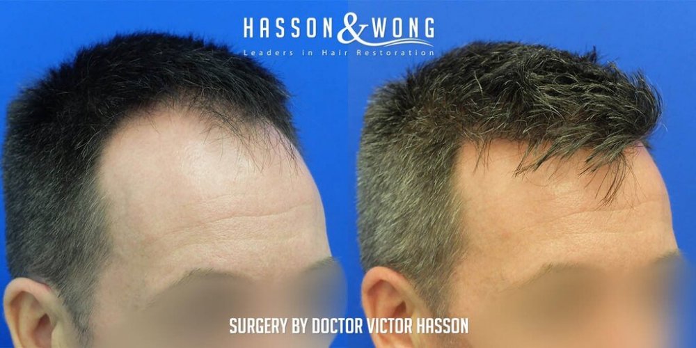 FUE Hair Transplant with Dr. Victor Hasson7.jpg
