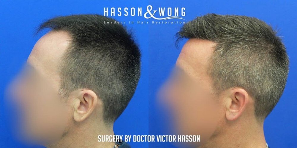FUE Hair Transplant with Dr. Victor Hasson8.jpg