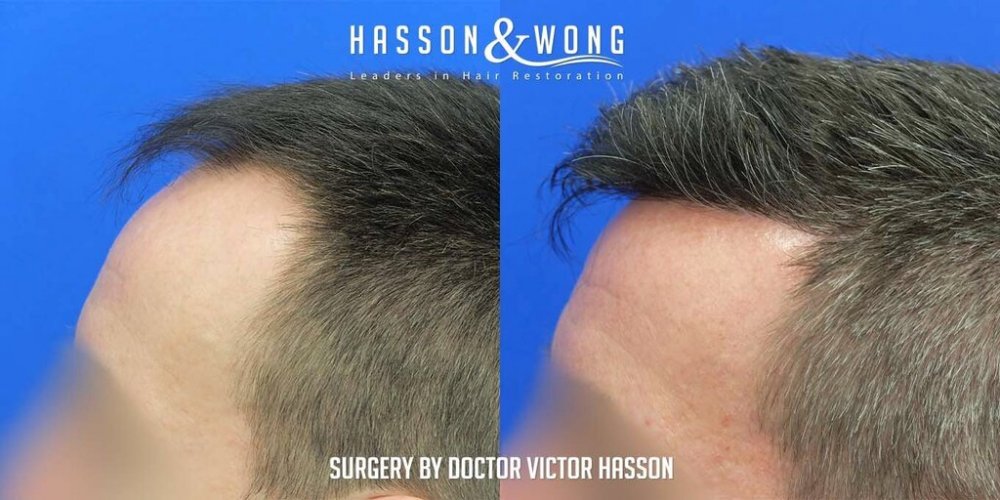FUE Hair Transplant with Dr. Victor Hasson9.jpg