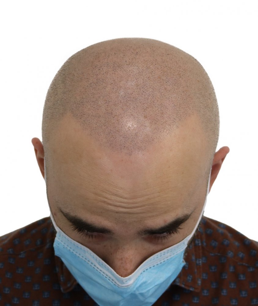 FUE hair transplantation fixed using hair pigmentation for short hair style after.jpg