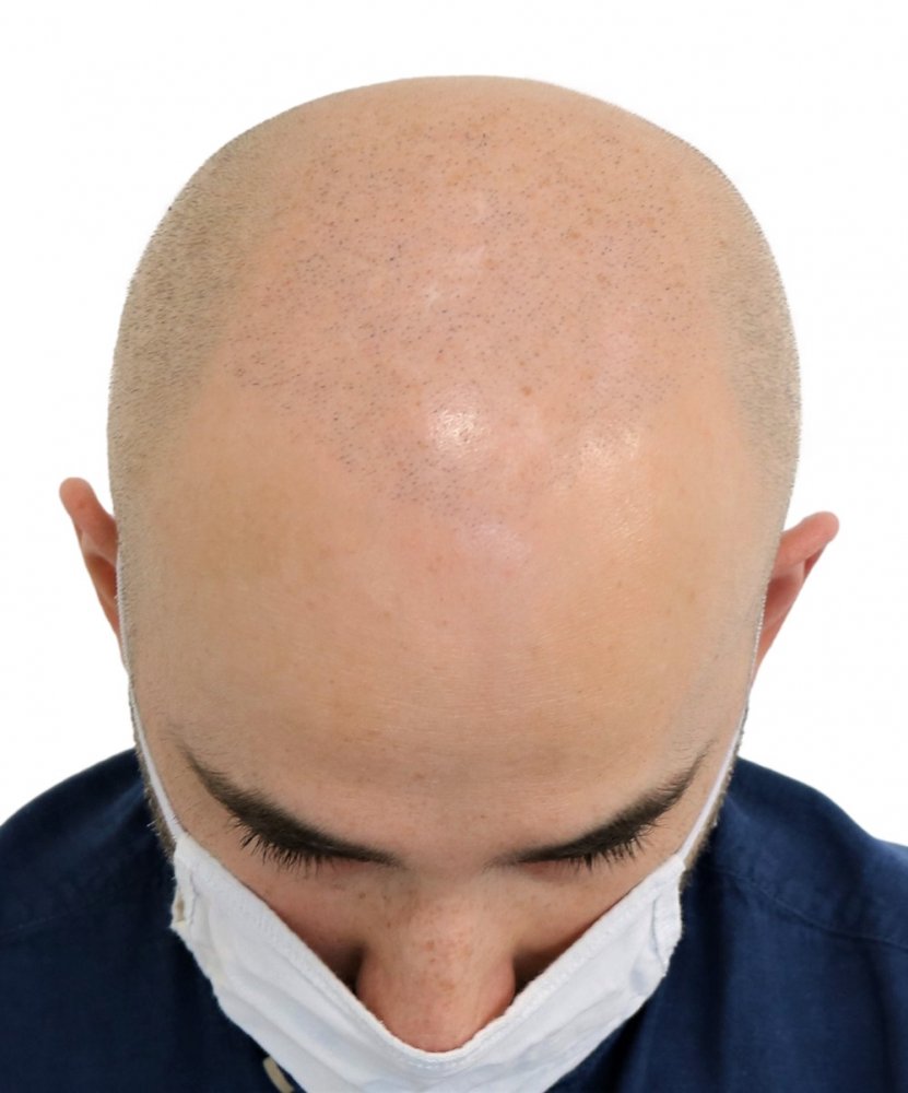 FUE hair transplantation fixed using hair pigmentation for short hair style before.jpg