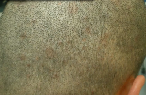 FUE scar.png