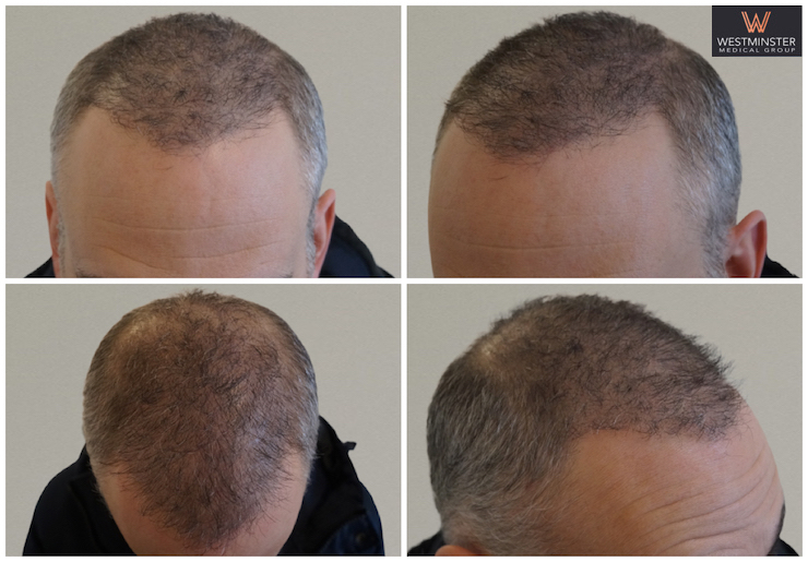 FUE & SMP Repair .jpg