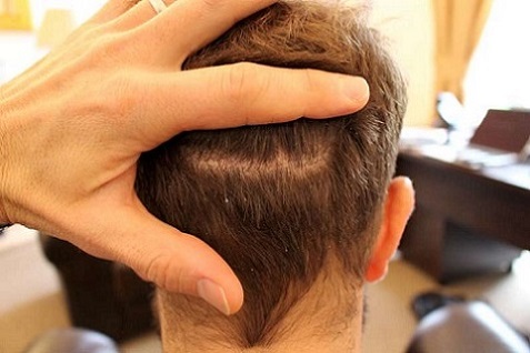 FUT Donor Scar.jpg